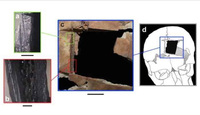 Detalhes da trepanação da cabeça do indivíduo e um gráfico mostrando o local da cirurgia. (Créditos: Kalisher et al., 2023, PLOS ONE, CC-BY 4.0)