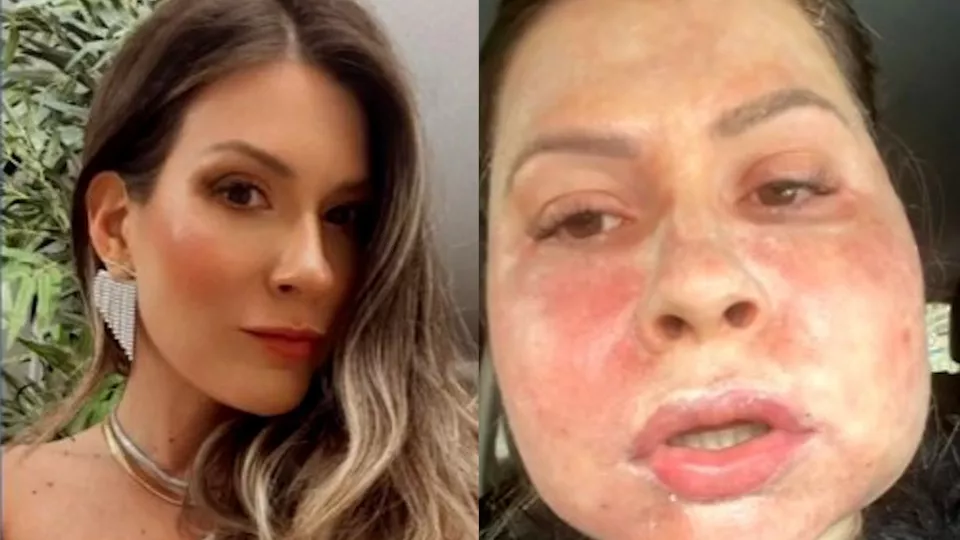 Profissionais de Cascavel são indiciados por 'dano irreversível' no rosto de paciente